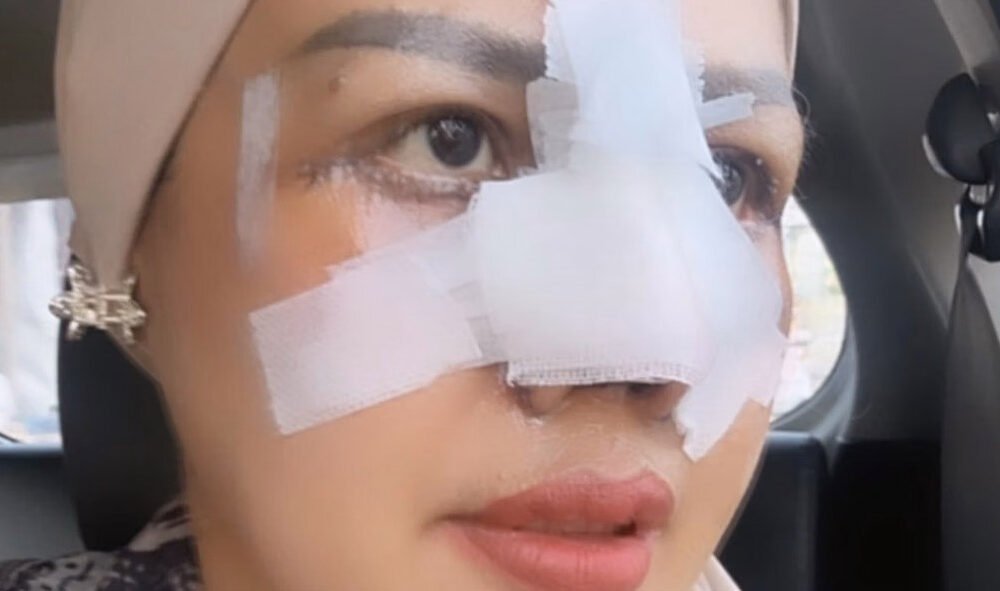 Elly Sugigi Bongkar Biaya Operasi Plastik Rp85 Juta, Akui Tak Keluar Uang Sepeser Pun